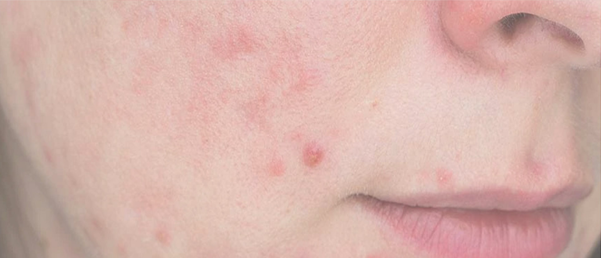 Bahan Skincare untuk Kulit Sensitif yang Perlu Dihindari